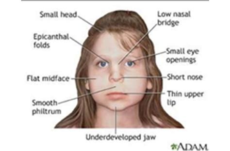 Beta Thalassemia Major (Cooley Anemia) .